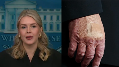 Karoline Leavitt reveals why there are bandages on Trump’s hand: ‘The president is literally…’