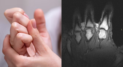 Does cracking your knuckles make them bigger? Scientists finally settle long-standing myth |