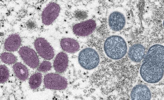 New recombinant mpox strain detected in UK and India, WHO urges continued monitoring