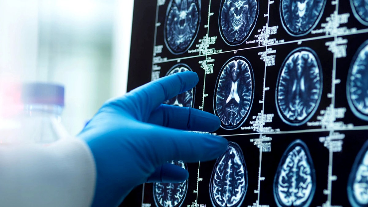 Common bacterium in the eye linked to Alzheimer’s, study finds