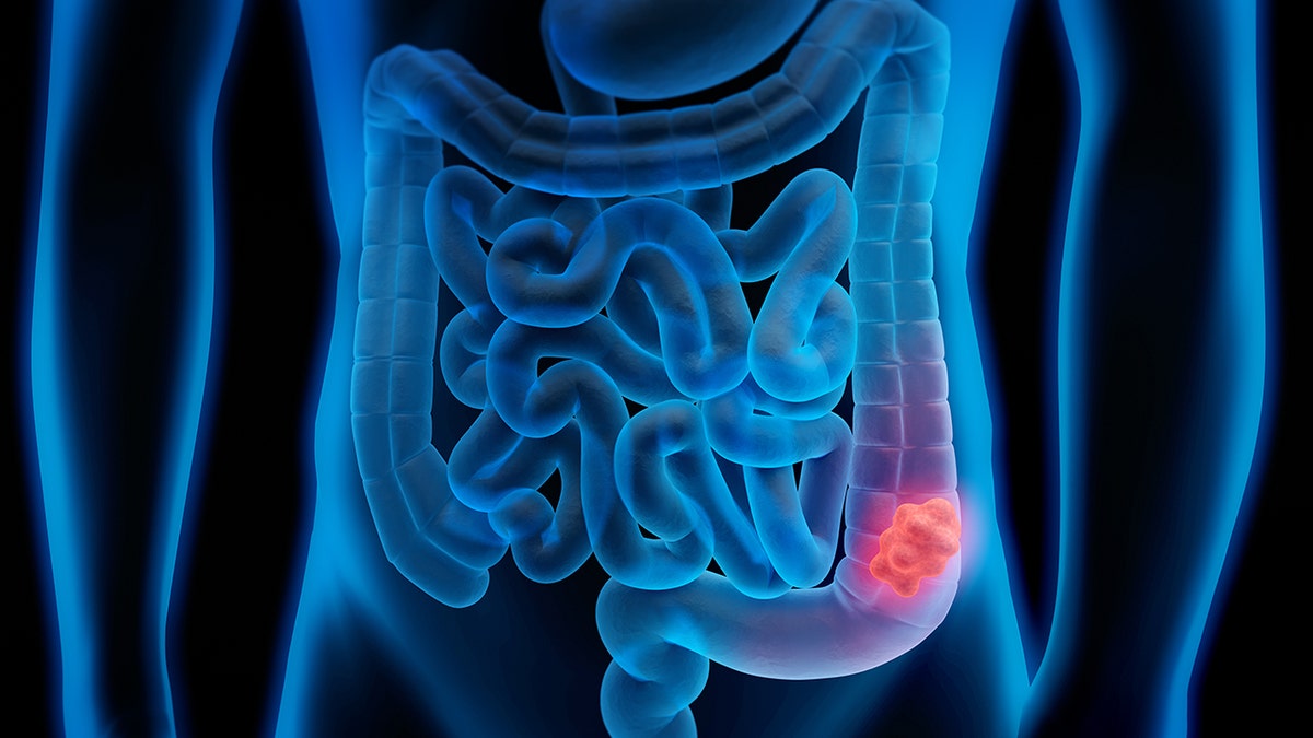 Virus in gut bacteria may be linked to colorectal cancer risk, study finds