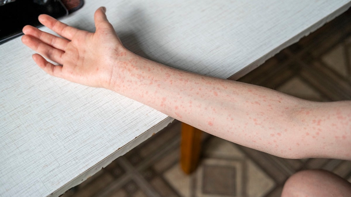 Measles outbreak hits Ave Maria University in Florida with 40+ cases
