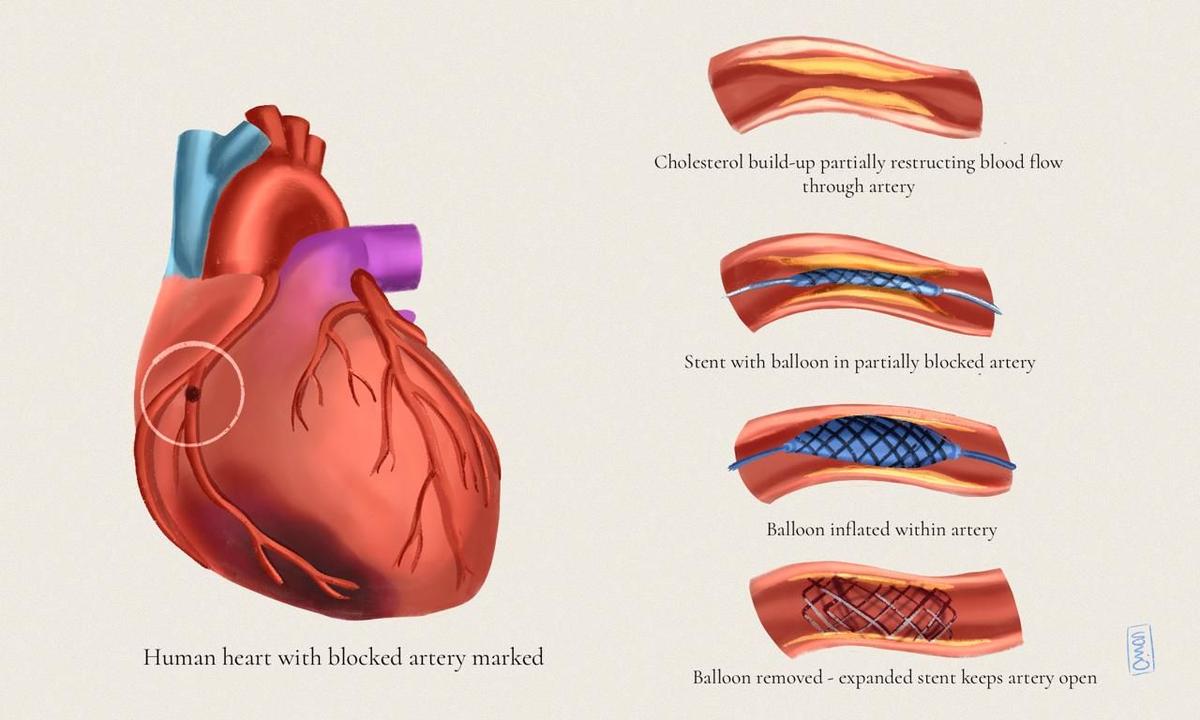 Heart disease kills 28.6 lakh Indians every year and yet, treatment is uneven and erratic