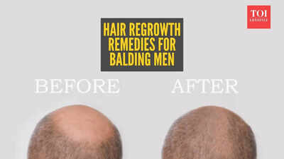 Reverse male pattern baldness: Home remedies for hair regrowth in balding men